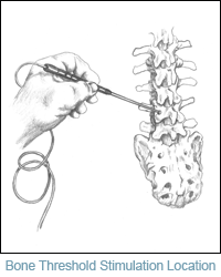 Bone Threshold